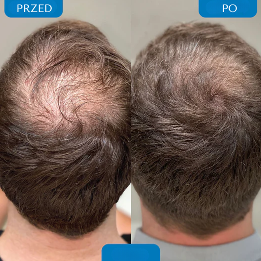 Serum na porost włosów