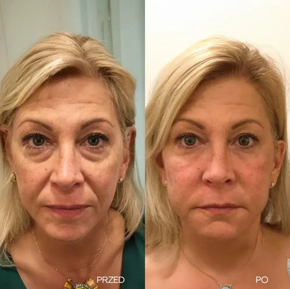 Krem Liftingujący V-Lift