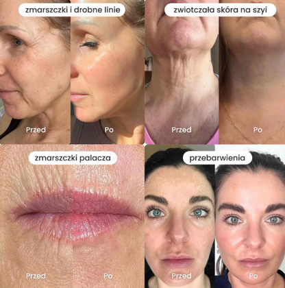Nuvelle - System Mikroinfuzji + Serum