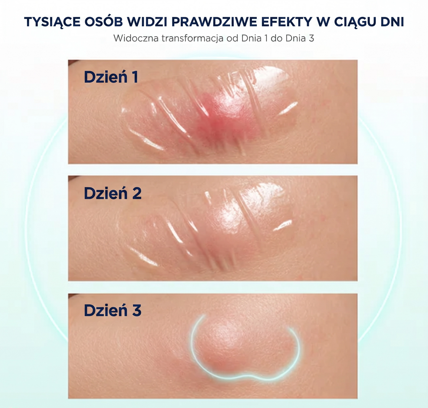 Hydrokoloidowy plaster w rolce – opatrunek chłonny do wilgotnego gojenia ran